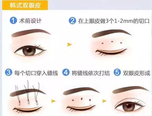 戚薇霸气公开割双眼皮,你还在犹豫吗?