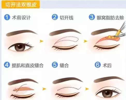 戚薇霸气公开割双眼皮,你还在犹豫吗?