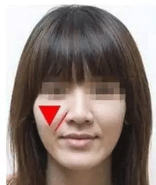 苹果肌下垂1厘米,显老5岁!!!