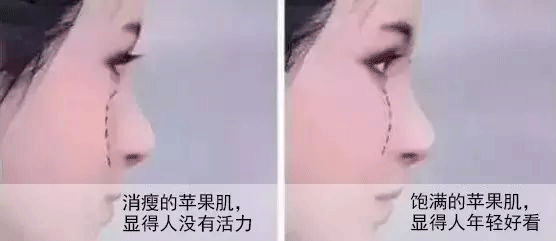 苹果肌下垂1厘米,显老5岁!!!