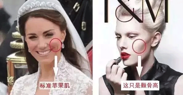 苹果肌下垂1厘米,显老5岁!!!