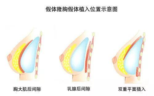 关于隆胸的这些疑惑,多方面解析看这里!