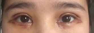湖南人民医院李波双眼皮开眼角提肌+切眼袋