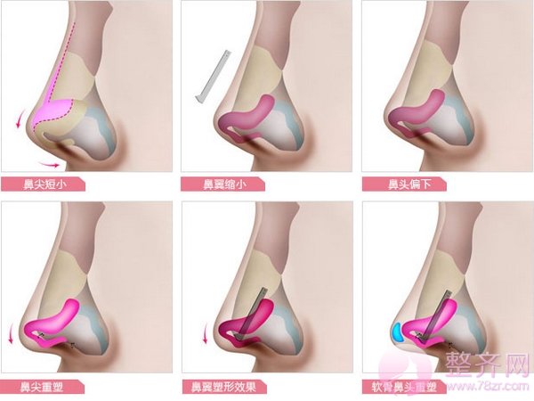 隆鼻?鼻部手术?该怎么选择?