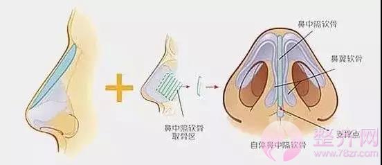 隆鼻?鼻部手术?该怎么选择?