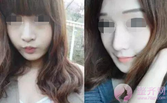 隆鼻?鼻部手术?该怎么选择?