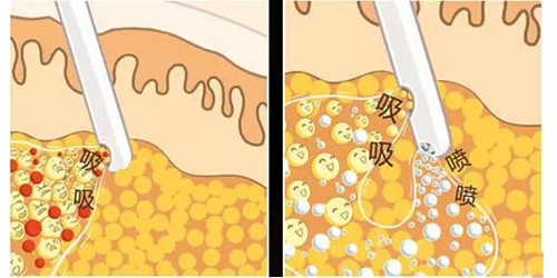 丰胸只是变大就好了吗?果较重要!