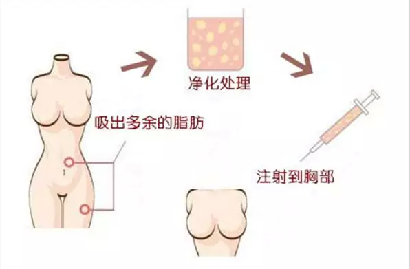 丰胸只是变大就好了吗?果较重要!
