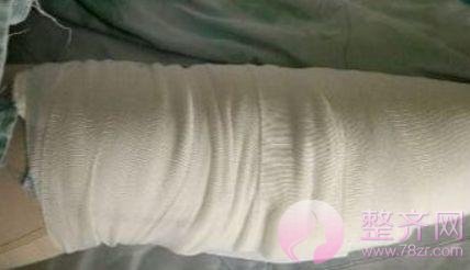 大腿吸脂术后护理&恢复过程