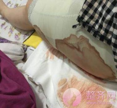 大腿吸脂术后护理&恢复过程