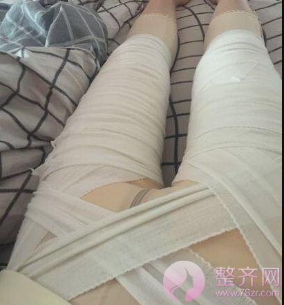 大腿吸脂术后护理&恢复过程