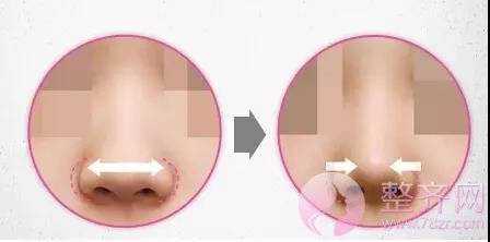 鼻翼缩小怎么做?我来告诉你!