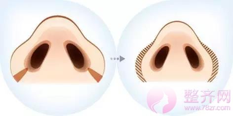 鼻翼缩小怎么做?我来告诉你!