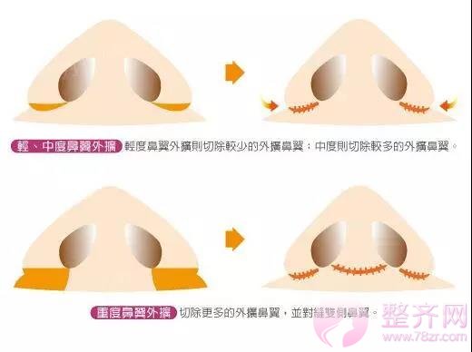 鼻翼缩小怎么做?我来告诉你!