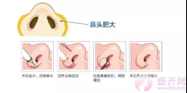 鼻翼缩小怎么做?我来告诉你!