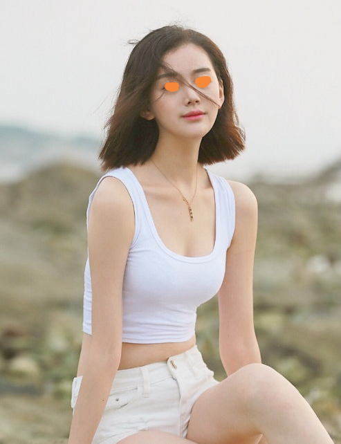 鼻部手术5个月案例,果简直不要太好