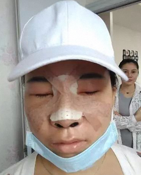 鼻部手术5个月案例,果简直不要太好