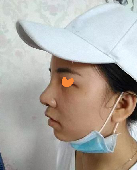 鼻部手术5个月案例,果简直不要太好