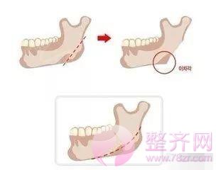下颌角真的非去不可吗?