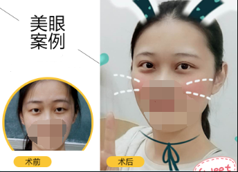埋线双眼皮怎么样,能维持多久?