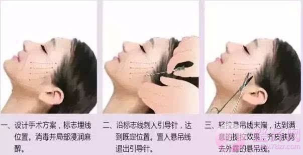 埋线提升,面部不老的秘密