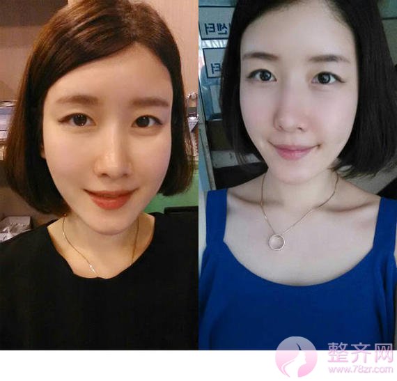 埋线提升,面部不老的秘密