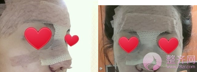 上海鼻部手术手术,面部填充术后5个月案例