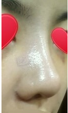 上海鼻部手术手术,面部填充术后5个月案例