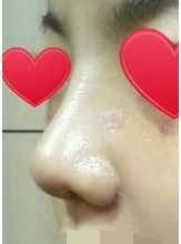 上海鼻部手术手术,面部填充术后5个月案例