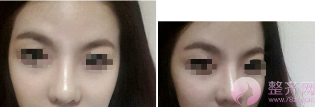 上海鼻部手术手术,面部填充术后5个月案例