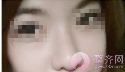 上海鼻部手术手术,面部填充术后5个月案例