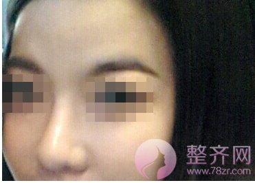 上海鼻部手术手术,面部填充术后5个月案例