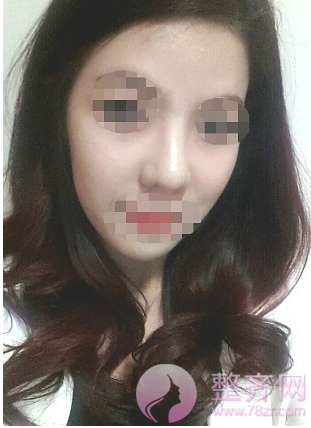 上海鼻部手术手术,面部填充术后5个月案例