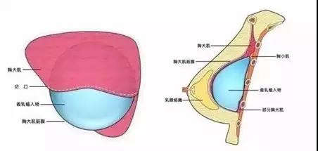 假体隆胸后,摸起来是什么感觉?
