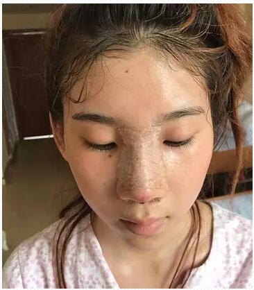 杭州格莱美李树平做的鼻部手术隆鼻术后恢复日记