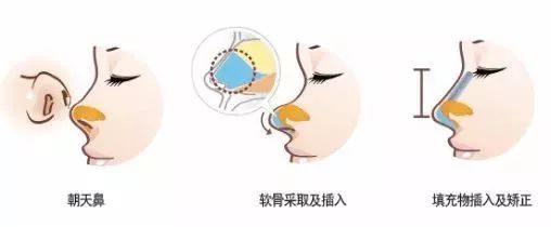 告别朝天鼻,再也不是猪鼻妹