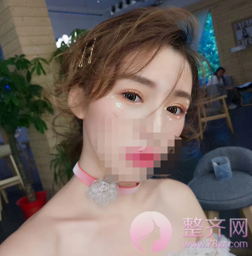 多大做双眼皮才合适?
