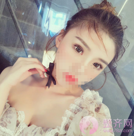 多大做双眼皮才合适?