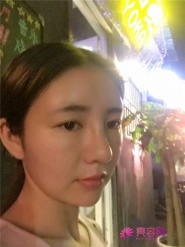 自从做了脂肪自体填充后心情很好,再也不怕和朋友出去聚餐了!!变得美美的,大家可不要羡慕我哦
