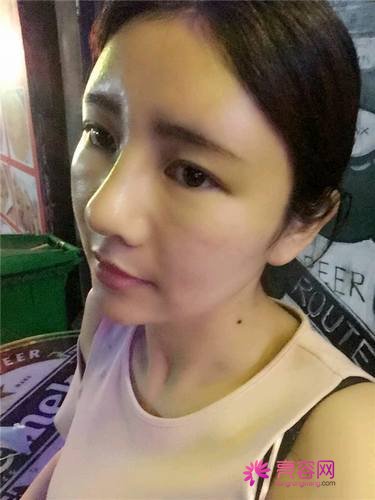 自从做了脂肪自体填充后心情很好,再也不怕和朋友出去聚餐了!!变得美美的,大家可不要羡慕我哦