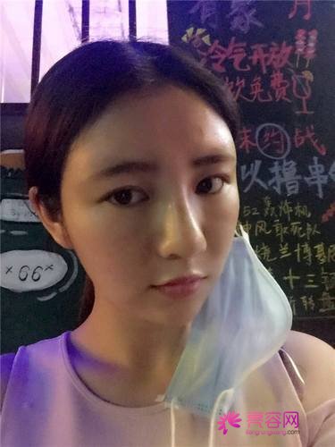 自从做了脂肪自体填充后心情很好,再也不怕和朋友出去聚餐了!!变得美美的,大家可不要羡慕我哦