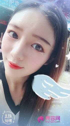 自从做了脂肪自体填充后心情很好,再也不怕和朋友出去聚餐了!!变得美美的,大家可不要羡慕我哦