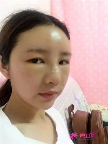 自从做了脂肪自体填充后心情很好,再也不怕和朋友出去聚餐了!!变得美美的,大家可不要羡慕我哦