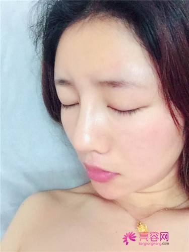 自从做了脂肪自体填充后心情很好,再也不怕和朋友出去聚餐了!!变得美美的,大家可不要羡慕我哦
