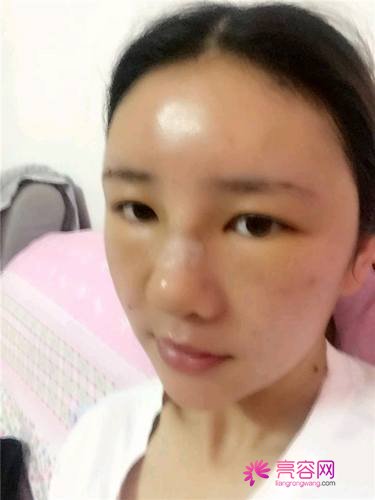 自从做了脂肪自体填充后心情很好,再也不怕和朋友出去聚餐了!!变得美美的,大家可不要羡慕我哦