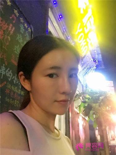 自从做了脂肪自体填充后心情很好,再也不怕和朋友出去聚餐了!!变得美美的,大家可不要羡慕我哦