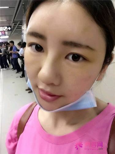 自从做了脂肪自体填充后心情很好,再也不怕和朋友出去聚餐了!!变得美美的,大家可不要羡慕我哦