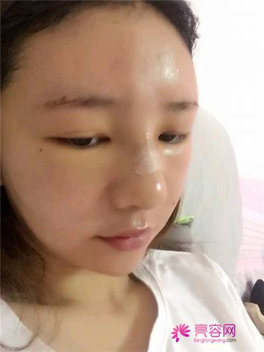 自从做了脂肪自体填充后心情很好,再也不怕和朋友出去聚餐了!!变得美美的,大家可不要羡慕我哦