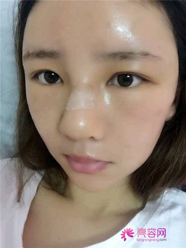 自从做了脂肪自体填充后心情很好,再也不怕和朋友出去聚餐了!!变得美美的,大家可不要羡慕我哦
