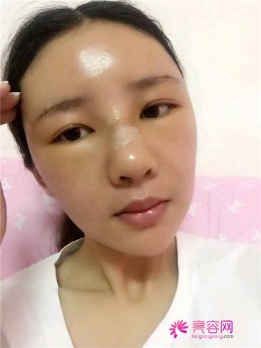 自从做了脂肪自体填充后心情很好,再也不怕和朋友出去聚餐了!!变得美美的,大家可不要羡慕我哦